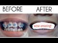 BRACES TIME LAPSE ( March 2017 to March 2019)