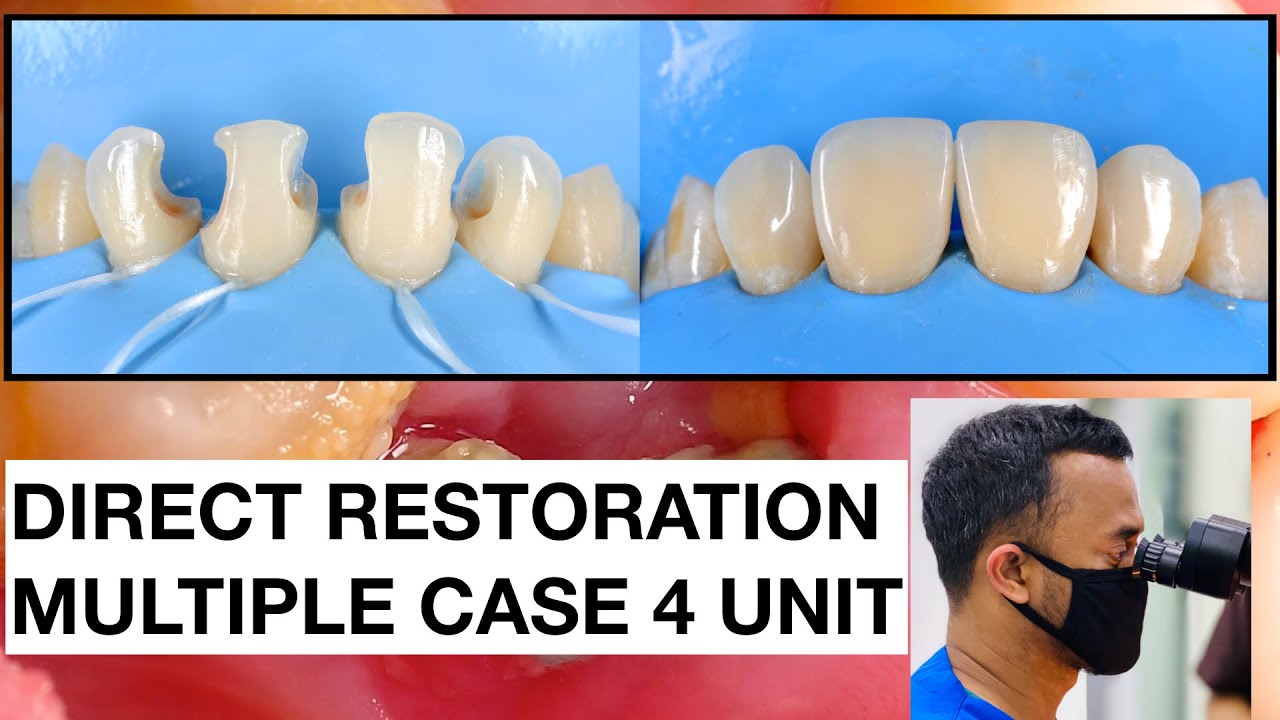 Direct restoration multiple case 2x speed tambal gigi dokter gigi