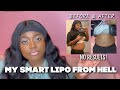 STORYTIME: My Smart Lipo 360  Experience from Hell