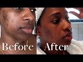 How I am currently getting rid of my post acne scars | 3 products that has changed my life