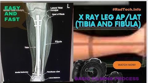 x ray leg ap/lat | x ray leg ap lateral position | Filming process | X ray Tibia and Fibula ap/lat 🔥