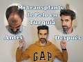 Transplante de pelo en Turquía: Mi experiencia.