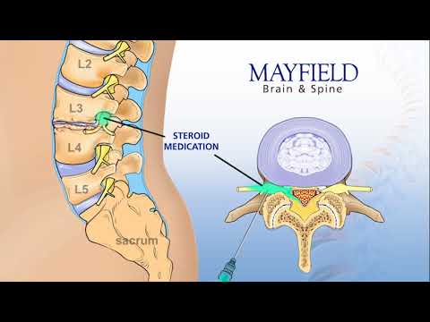 Instead of permanently joining (fusing) vertebrae with metal rods and screws, and therefore restrict. 