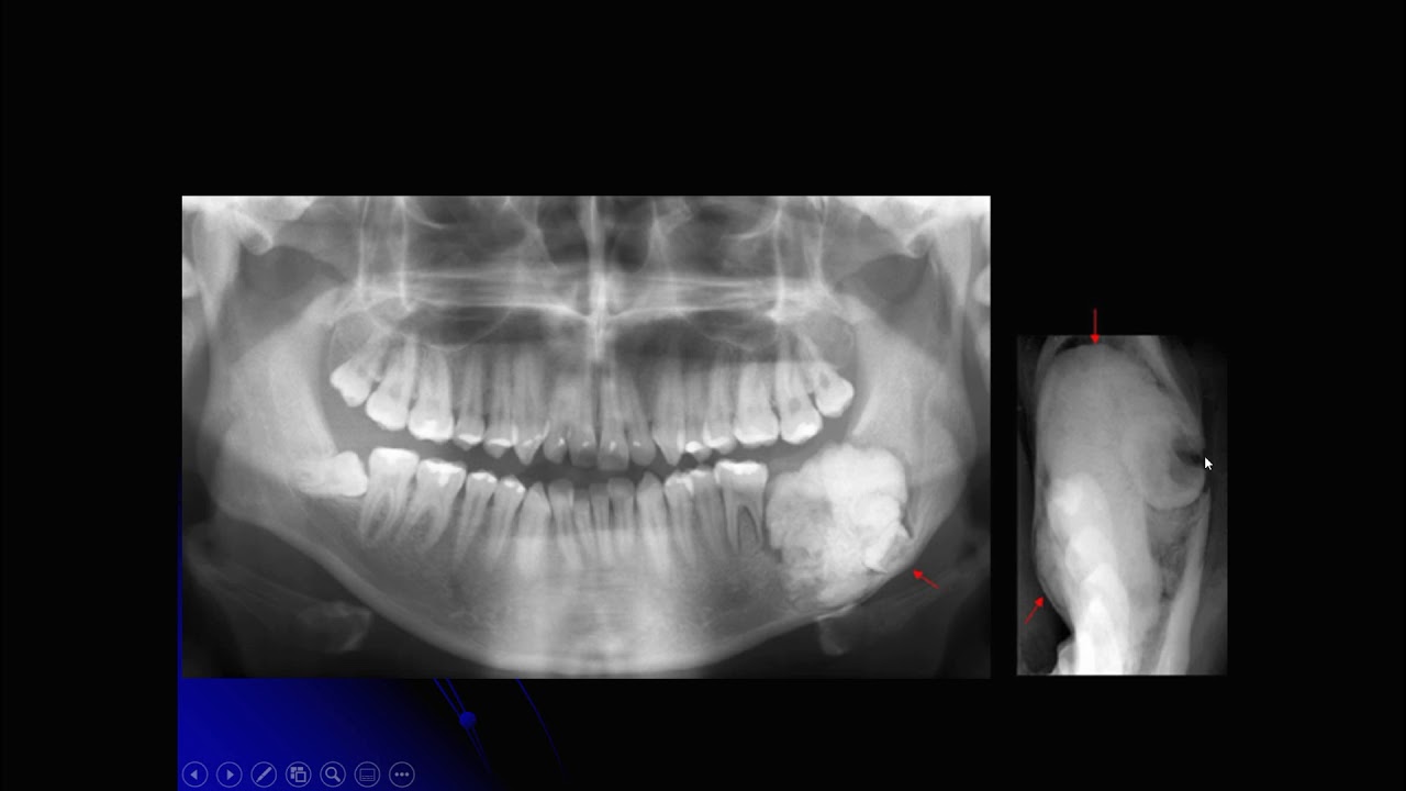 Aula de Cistos e Tumores Odontogênicos