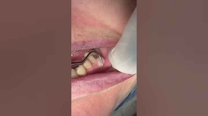 Tooth abscess inflammation #satisfying