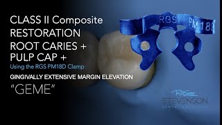 Do Composite With Margin Elevation #20 | Class ll Composite