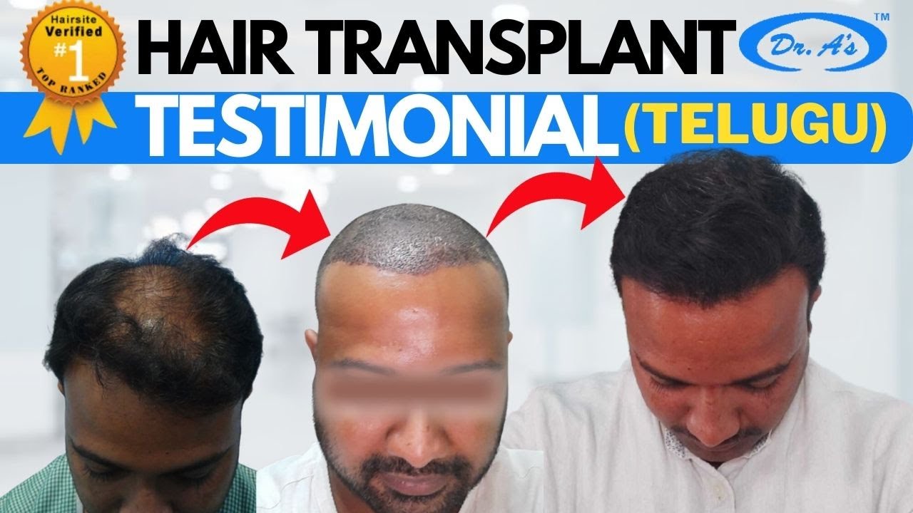 Hair Transplant in Hyderabad Best Results & cost of Hair Transplant