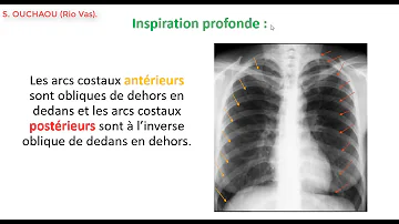 Comment interpréter une radiographie du thorax ?