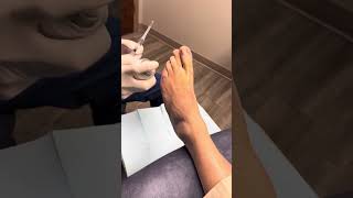 Ingrown toenail procedure Part 1, local anesthesia