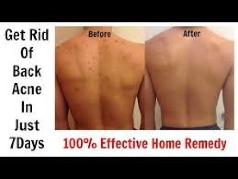 This cinnamon pack will get rid of all back and chest acne! Home Remedy for Back acne