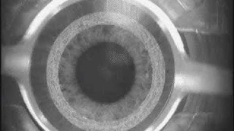 Intacs Channel made with IntraLase