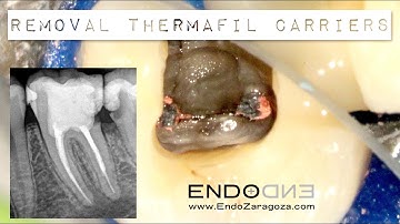 REMOVAL THERMAFIL CARRIERS ENDODONTIC RETREATMENT