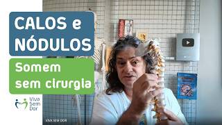Calos, lipomas e nódulos são reabsorvidos ao descomprimir os nervos