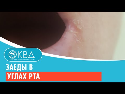 😕 Заеды в углах рта. Клинический случай №911
