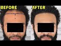 INCREDIBLE BEFORE/AFTER AFRICAN AMERICAN HAIR TRANSPLANT RESULTS!