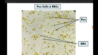 Stool Analysis 10 Mucous Pus RBCs فحص الخلايا الصديدية وخلايا الدم الحمراء تحت الميكرسكوب