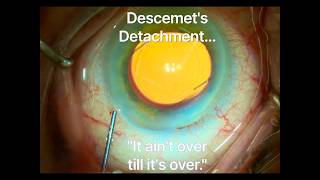 Descemet&#39;s detachment during cataract surgery.  &quot;It ain&#39;t over till it&#39;s over.&quot; Shannon Wong, MD