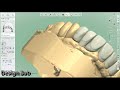 3shape design implant case anterior teeth    6 units