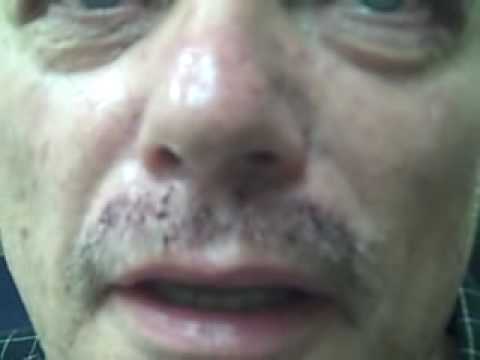 Dr. Epstein's review on Male Patient, Eyebrow, Moustache and Chest Hair