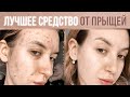 Как избавиться от прыщей | Как я избавилась от АКНЕ