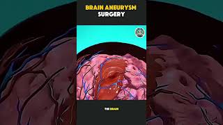 How Doctors Remove a Brain Aneurysm | Medical 3D Animation