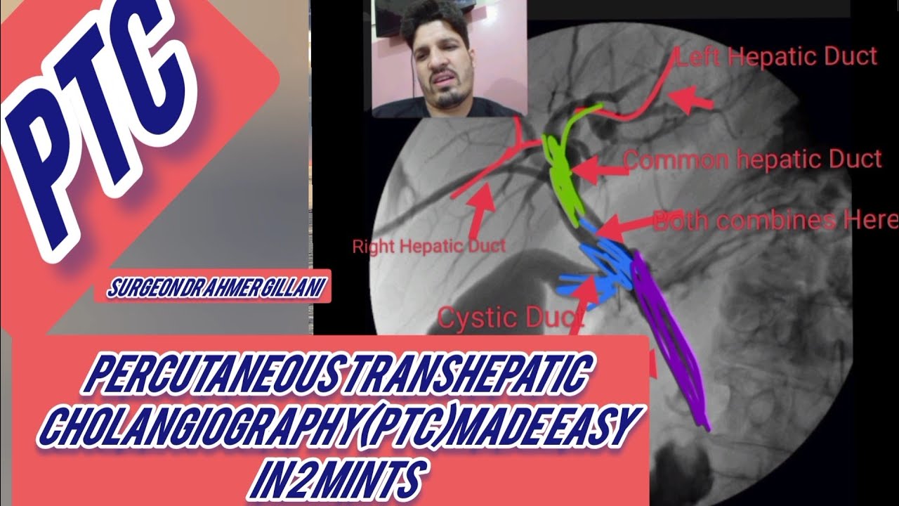 PTC(percutaneous Transhepatic Cholangiography) Made Easy - YouTube