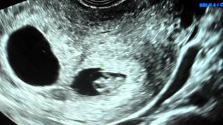 8 week ultrasound TWINS with heartbeats. IVF