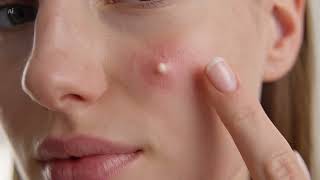 Le Miracle Anti Bouton