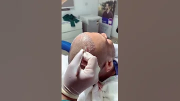 كيف تتم زراعة الشعر زراعة الشعر 