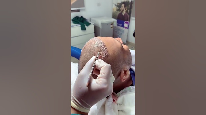 كيف تتم زراعة الشعر #زراعة_الشعر