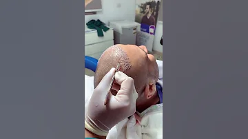 كيف تتم زراعة الشعر زراعة الشعر 