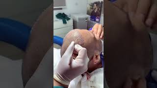 كيف تتم زراعة الشعر زراعة_الشعر