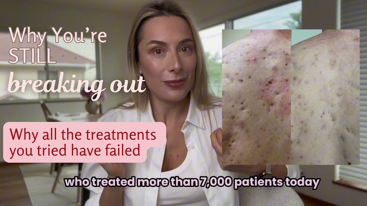 Why Your Acne Treatment Never Worked (and How to Finally Fix It)
