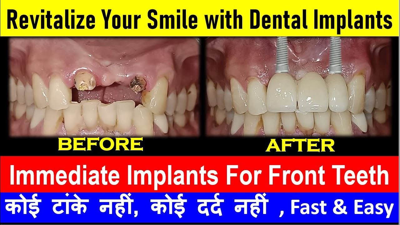 Front Teeth Dental Implants Best Implant Centre in Delhi NCR BANDHU