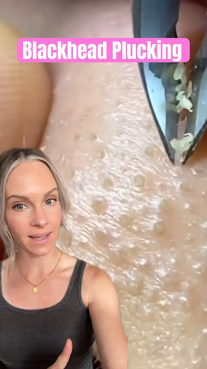 Download lagu MOST SATISFYING BLACKHEAD PLUCKING REMOVAL #shorts