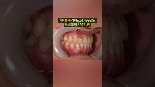 #반대교합교정. 서울대교정과전문의에게 치료받는 가성비좋은 반대교합교정 (02 886 2877 신도림역 가이치과) #반대교합교정 #3급부정교합교정 #주걱턱교정 #비수술주걱턱교정