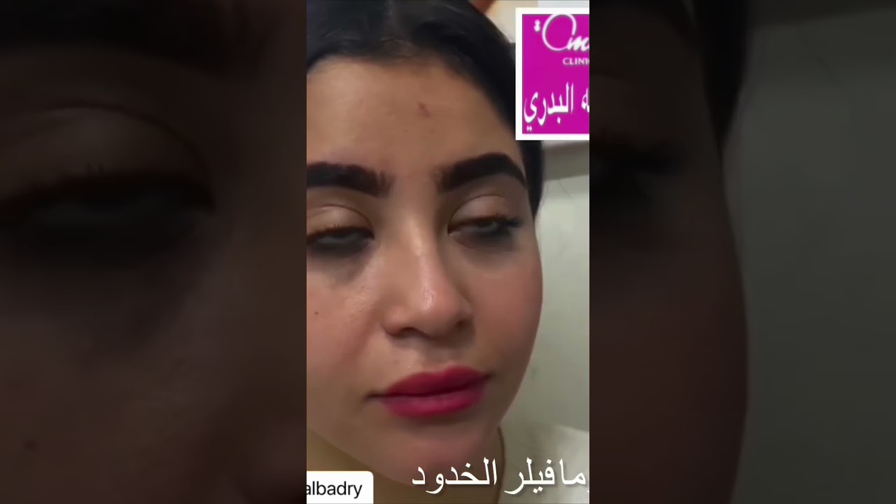 قبل وبعد حقن الوجه بلازما فيلر #دكتوره_امينه_البدري #بلازما #بلازما_فيلر