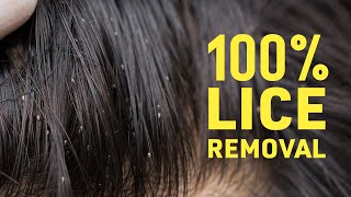 Get Rid Of Lice COMPLETELY | Safe \& Natural Home Remedies For Lice \& Nits