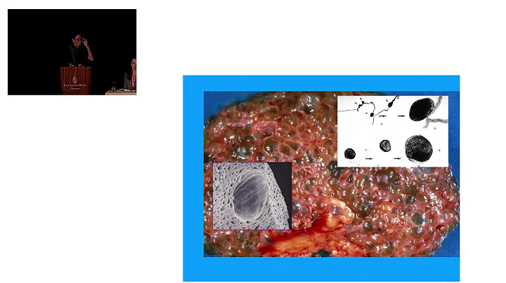 ADPKD: What Have We Learned Over The Past decade