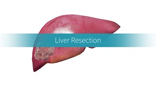 Liver Resection: How and Why the Procedure Is Performed by Cancer Center  9,110 views 9 months ago 1 minute, 48 seconds