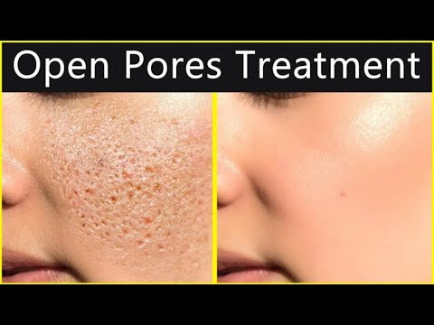 Natural Home Remedies To Close Open Pores - YouTube