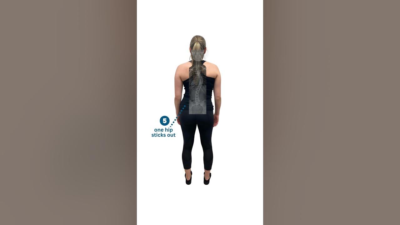 scoliosis-sign-5-one-hip-sticks-out-youtube