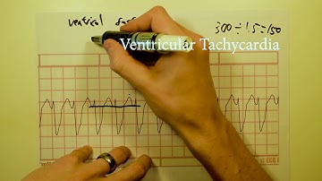 ECG/EKG interpretation (basics) COURSE Part 2 of 3 ~  12 lead ECG analysis.