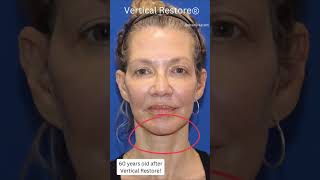 20 years YOUNGER after Vertical Restore® Facelift