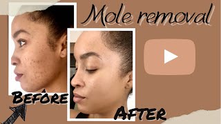 Mole Removal Vlog |start to finish| What to expect DPN removal/ Before&After care tips by Stephanie Renee’ 4,418 views 2 years ago 12 minutes, 41 seconds