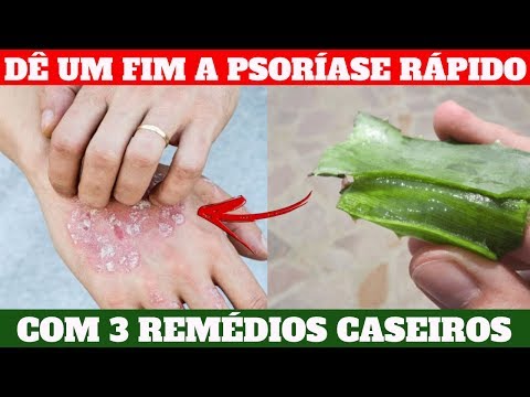 Vídeo: 4 maneiras de tratar a psoríase naturalmente