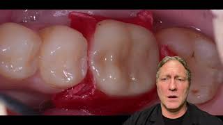 Tip of the Day: Primescan DI Image into Implant Design