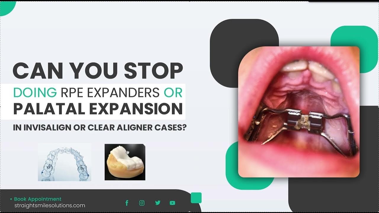 Can you Use INVISALIGN for Palatal Expansion in Mixed Dentition Cases