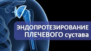 Эндопротезирование плечевого сустава. Операция эндопротезирования плечевого сустава.(Операция эндопротезирования плечевого сустава. https://goo.gl/lm7Mu2 Врач травматолог ортопед Армен Петросян расск..., 2016-10-30T22:22:10.000Z)