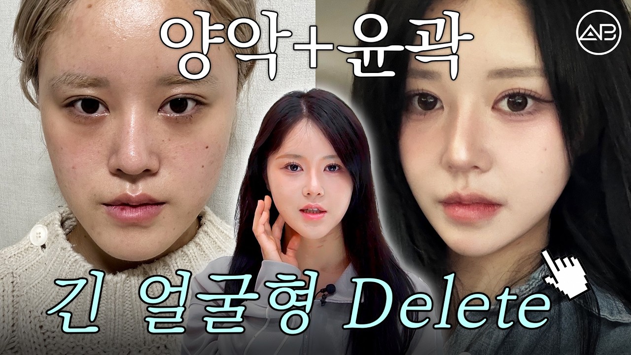 안면윤곽+양악수술 7개월 경과 | 긴얼굴·주걱턱이 이렇게 달라질 수 있다고? 😳 | 에이비성형외과